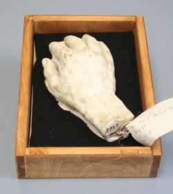 Abguss der rechten Hand Robert Kochs (1843-1910)
